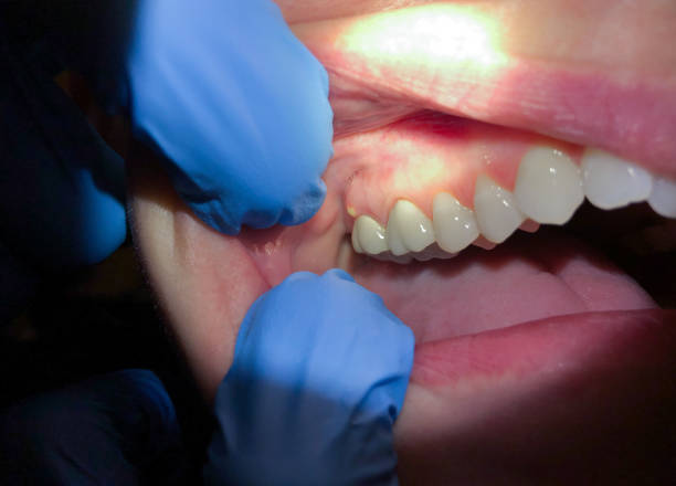 Best Emergency Tooth Extraction in Jackson, WI